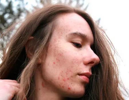 Acne Treatment Service